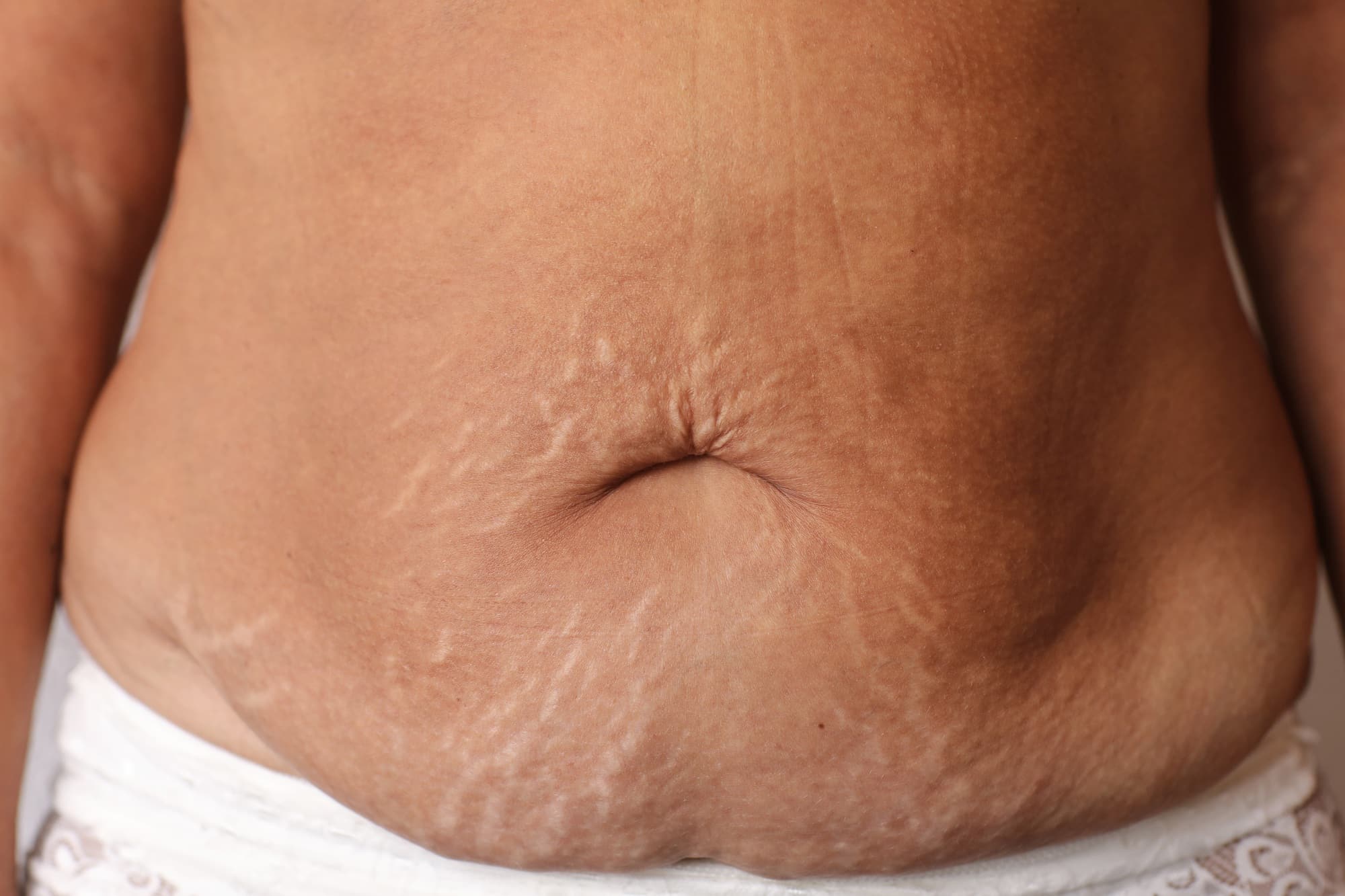 Close up of woman's belly with stretch mark loose lower abdomen skin she fat after pregnancy baby