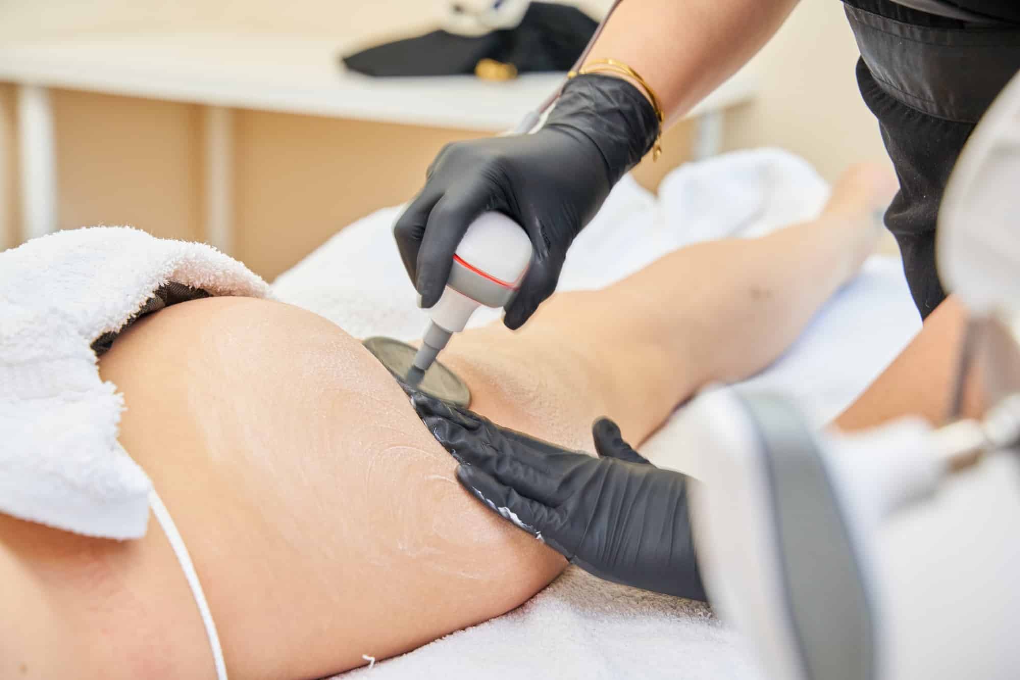cosmetologist using radiofrequency device and removing stretch marks on female buttocks.